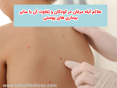 علائم آبله مرغان در کودکان