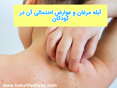 آبله مرغان و عوارض احتمالی آن بر کودکان