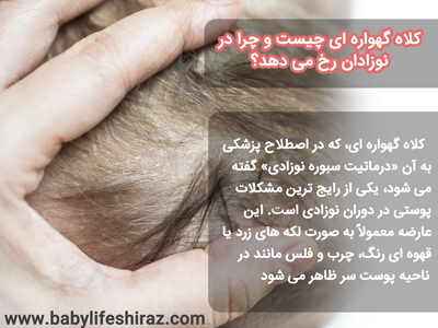 کلاه گهواره ای چیست و چرا رخ میدهد